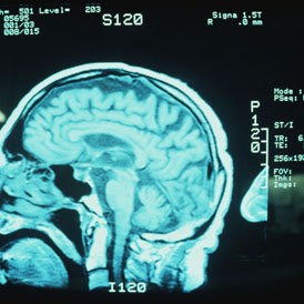 A CAT scan of a brain (Getty)