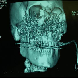 Simon's skull after he was shot
