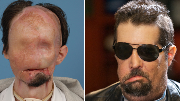 The first man to receive a full face transplant in the US is 26-year old Dallas Wiens (Reuters)