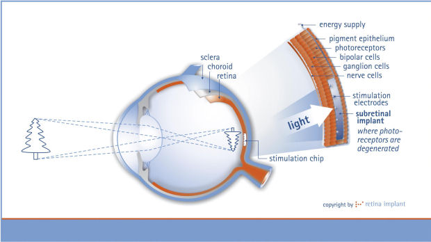 Graphic showing how the implant works (Retina Implant AG)