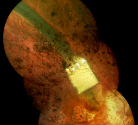 Scientists help blind man see again (Retina Implant AG)