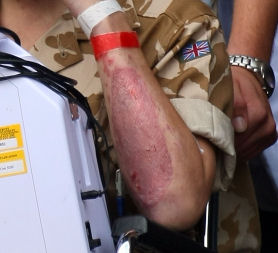 A soldier hurt in Afghanistan shows his injuries at the funeral of a comrade. (Credit: Getty)